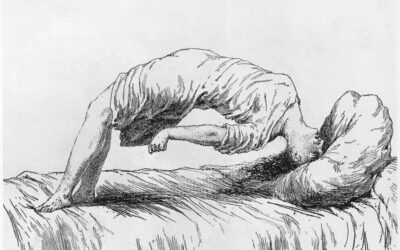 From hysteria to fibromyalgia